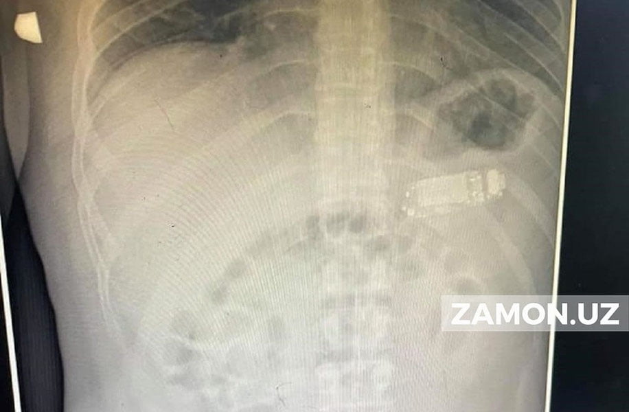 33 yoshli erkak mobil telefonini yutib yubordi