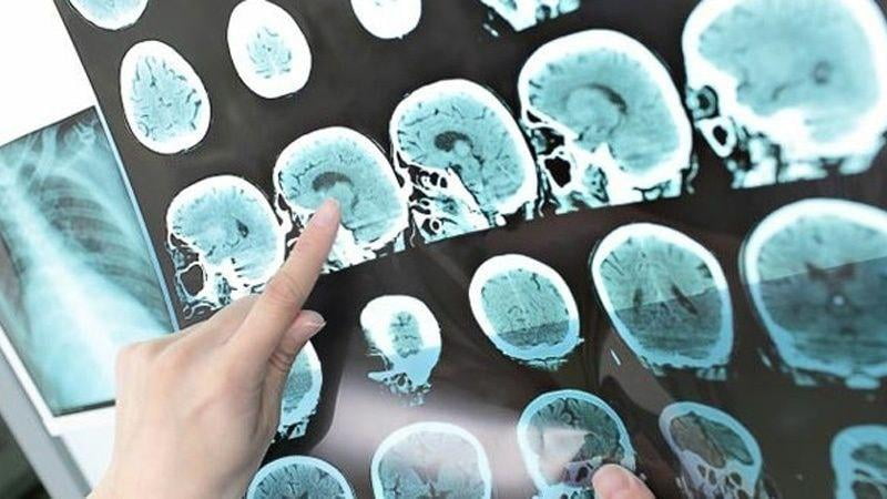 Дунёнинг 43,1 фоиз аҳолиси неврологик касалликлардан азият чекмоқда