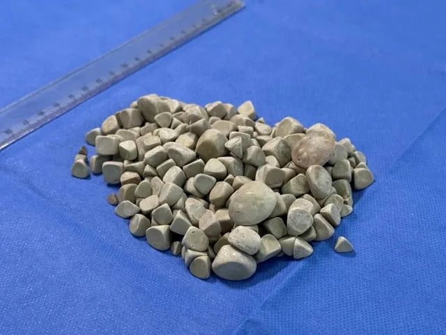 Туркияда 21 ёшли қизнинг танасидан 287 та тош олиб ташланди