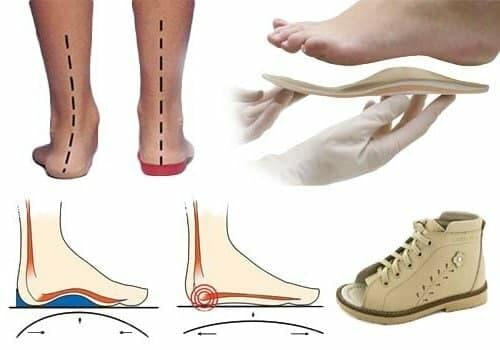 Қандли диабет билан касалланган беморлар учун ортопедик поябзал ихтиро қилинди