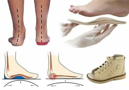 Қандли диабет билан касалланган беморлар учун ортопедик поябзал ихтиро қилинди