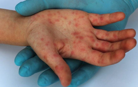 Ўзбекистонда хориждан келганлардан қизамиқ юқиш ҳолатлари ошди