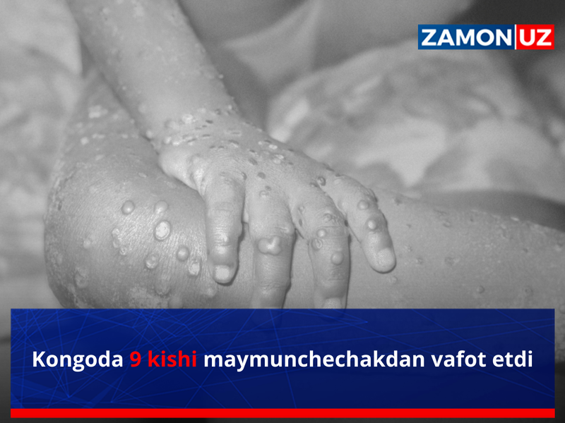 Конгода 9 киши маймунчечакдан вафот этди