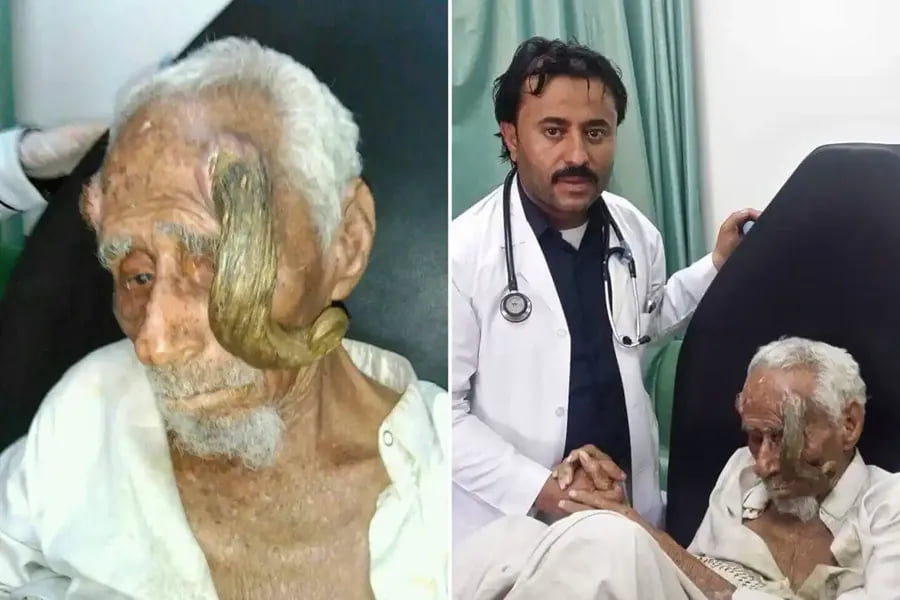 Dunyoning "ikki shoxli" odami vafot etdi