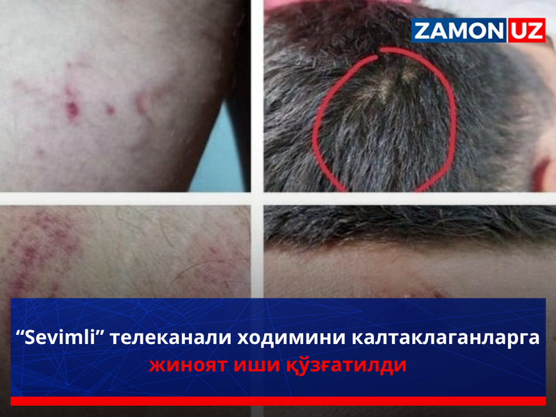“Sevimli” telekanali xodimini kaltaklaganlarga jinoyat ishi qo‘zg‘atildi