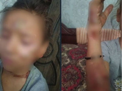 Бухоролик аёл қизининг юзига қизиган капкир босди