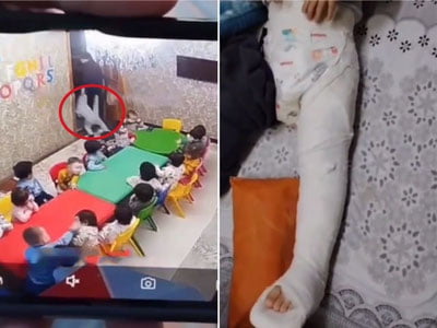 Toshkentdagi bog‘chada bola kaltaklanishi sabab oyog‘i sindi