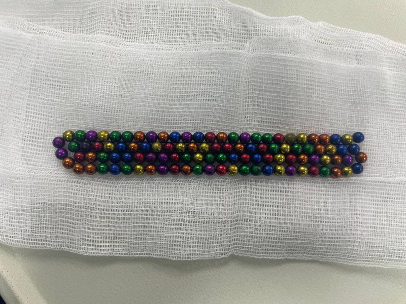 Qozog‘istonda 2 yoshli bola 105 ta magnit yutib yubordi