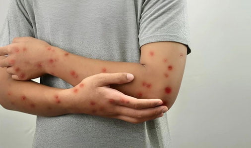 Avstraliyada Maymunchechakning yangi shtammi aniqlandi