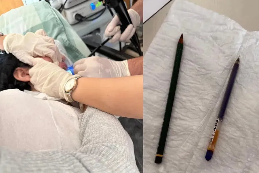 Turkiyada 22 yoshli bemorning oshqozonidan ikki ruchka chiqarildi